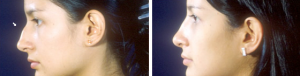 Rhinoplastie Tunisie